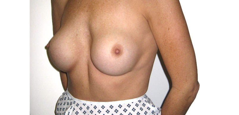 Before breast complex revision surgery